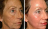2 jednoduché spôsoby, ako odstrániť vrásky na tvári doma bez chirurgického zákroku a bez kozmetička