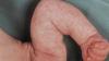 "Mramorová" koža u detí: norma alebo patológia? Neurológ odpovedá