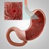 Gastritídu alebo erózia žalúdka: hlavné príznaky, liečba, diéta