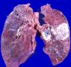 Rakovina pľúc: Ako sa ujsť začiatok choroby?