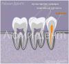 Ako nájsť a ošetrovať zubné kanály v Lumidenti