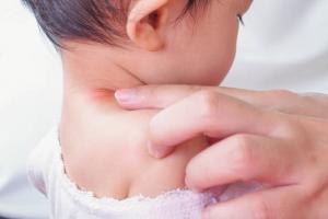 Pásový opar je dieťa: zdroje infekcie, príznaky a liečba