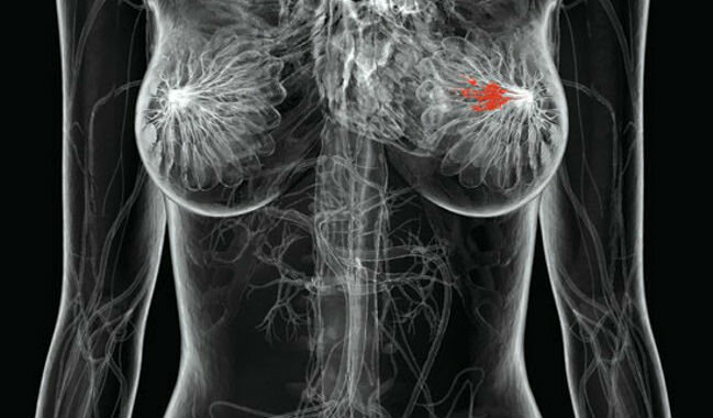Rakovina prsníka - prsné žľazy rakovina