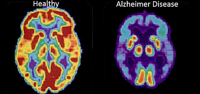 Alzheimerova choroba - Prvý obrázok - druhý mozog zdravého človeka, 