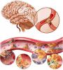 Mozgová ateroskleróza: ako sa správať, aké sú príznaky?