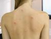 Ako sa zbaviť akné na chrbte