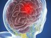 Nádory mozgu: 5 symptómy, ktoré nemôže byť ignorovaná