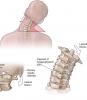 4 základné cvičenie pre krčnej chrbtice pomôže zabudnúť na bolesť a osteochondróze!