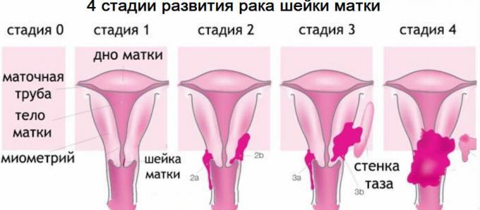 4 štádia rakoviny krčka maternice