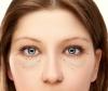 Ako sa zbaviť bez chirurgického zákroku, prietrže a spodné viečko oka vriec